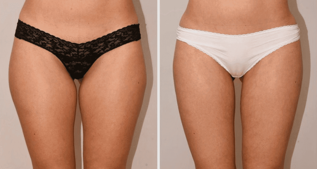 Vorher/Nachher Ergebnis: Eigenfett Bodyforming