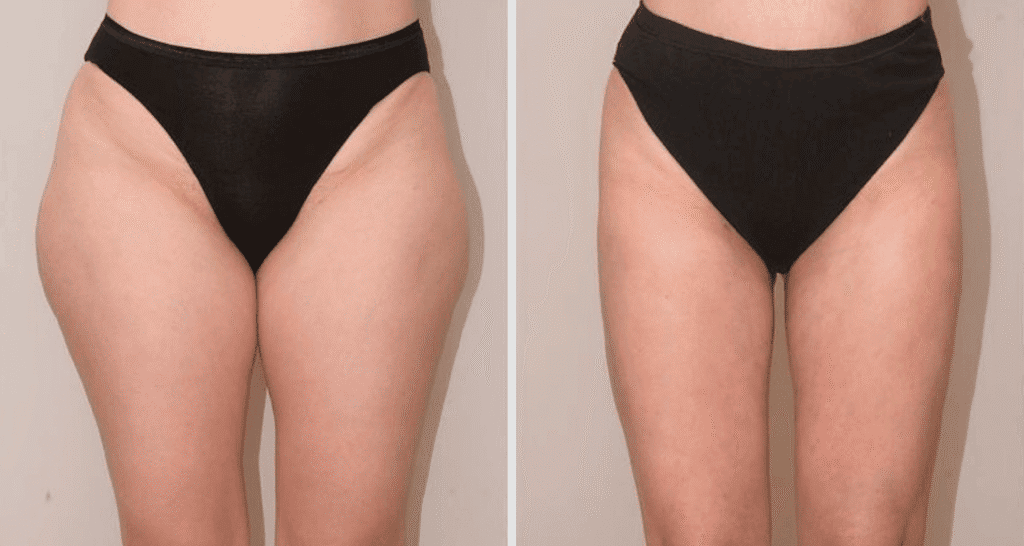 Vorher/Nachher Ergebnis: Eigenfett Bodyforming