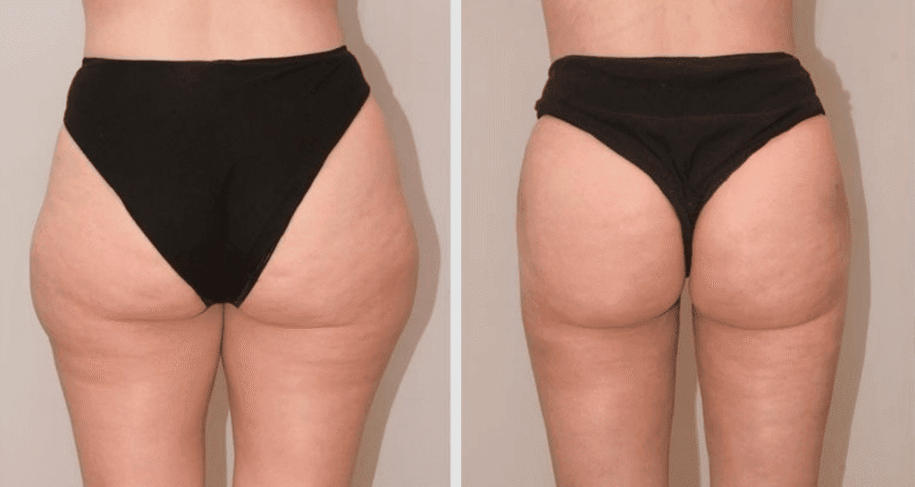 Vorher/Nachher Ergebnis: Eigenfett Bodyforming