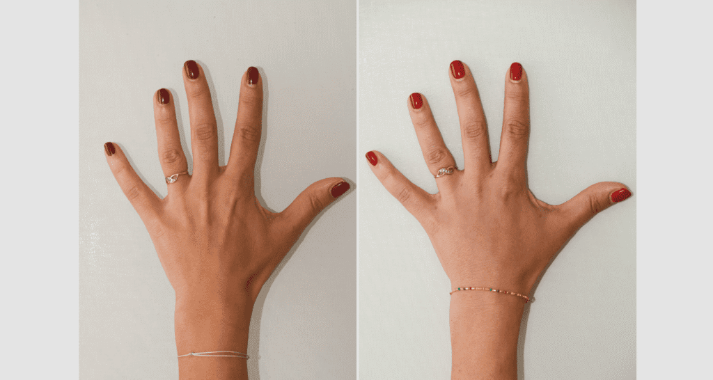 Vorher/Nachher Ergebnis: Eigenfett Haende