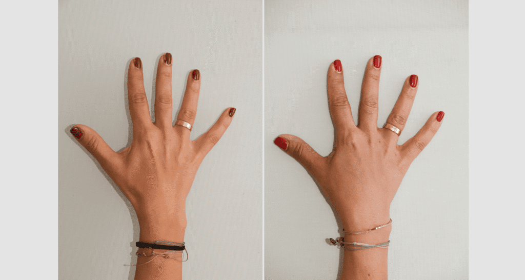 Vorher/Nachher Ergebnis: Eigenfett Haende