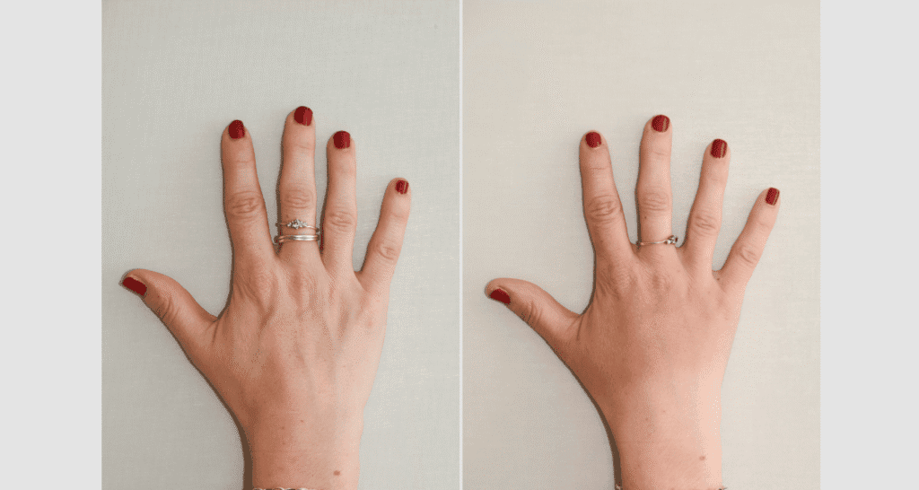 Vorher/Nachher Ergebnis: Eigenfett Haende