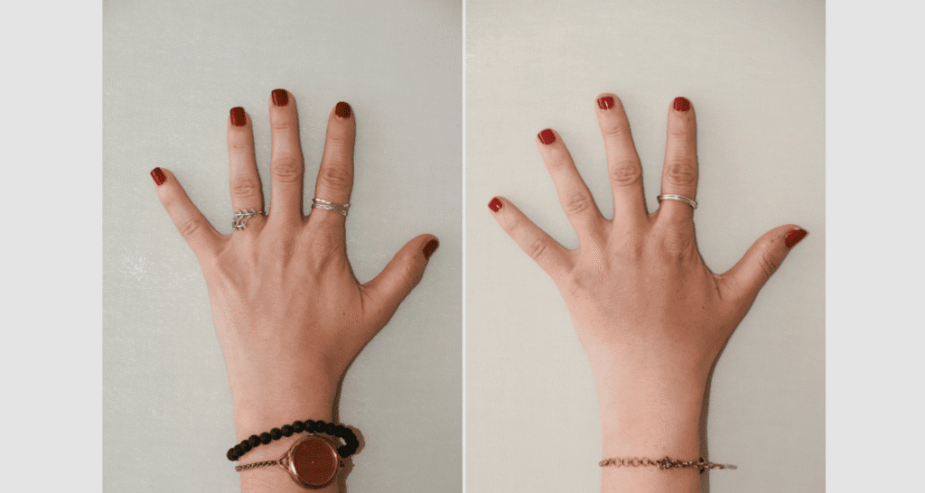 Vorher/Nachher Ergebnis: Eigenfett Haende