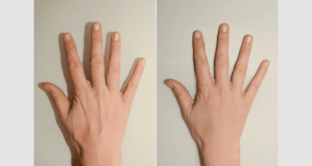 Vorher/Nachher Ergebnis: Eigenfett Haende