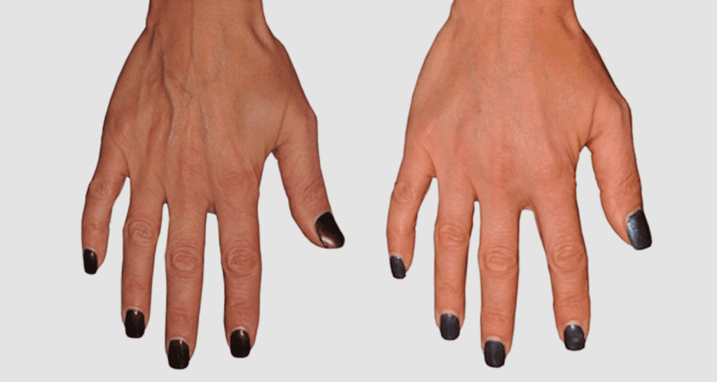 Vorher/Nachher Ergebnis: Eigenfett Haende