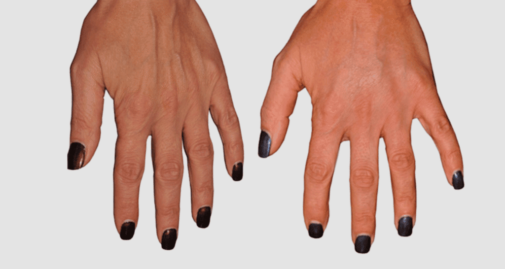 Vorher/Nachher Ergebnis: Eigenfett Haende