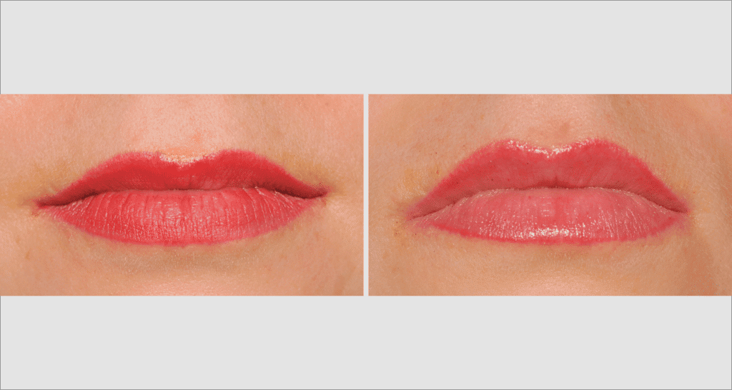 Vorher/Nachher Ergebnis: Eigenfett Lippen