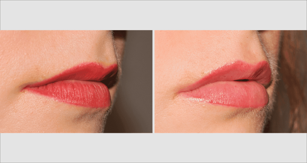 Vorher/Nachher Ergebnis: Eigenfett Lippen