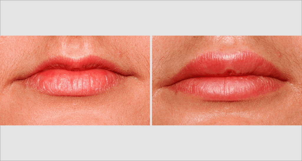Vorher/Nachher Ergebnis: Eigenfett Lippen