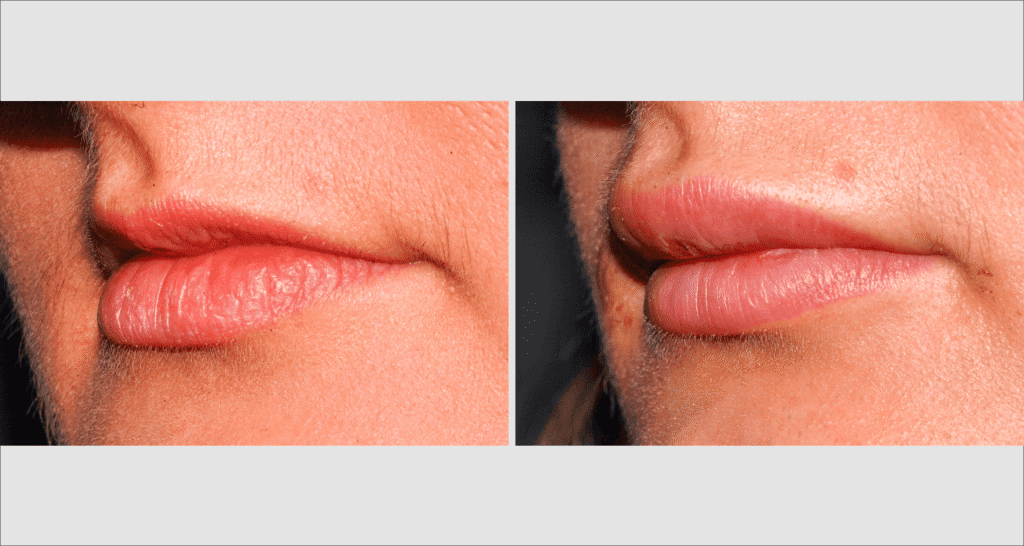 Vorher/Nachher Ergebnis: Eigenfett Lippen