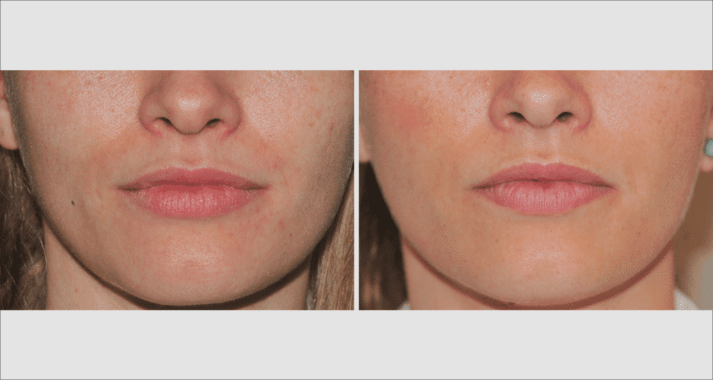 Vorher/Nachher Ergebnis: Eigenfett Lippen