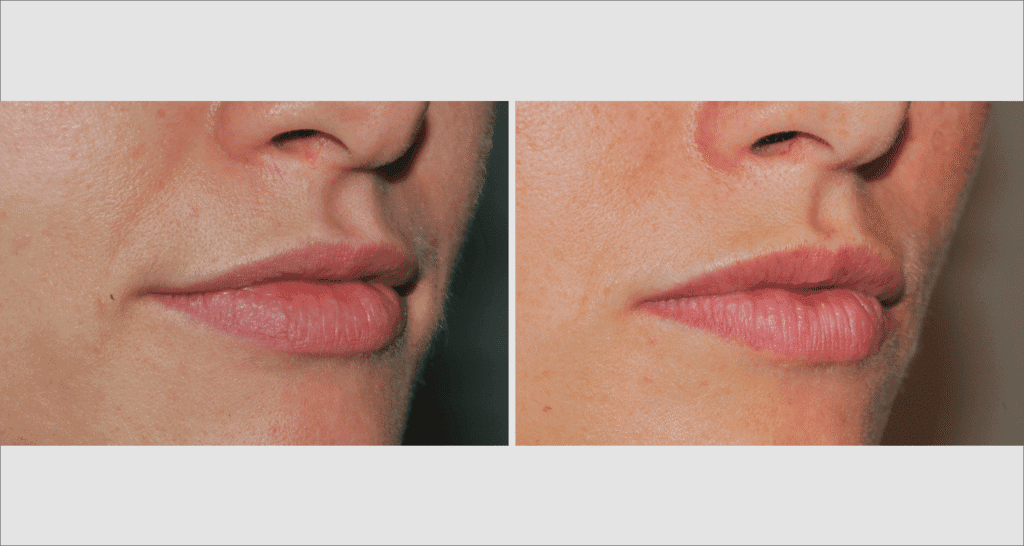 Vorher/Nachher Ergebnis: Eigenfett Lippen