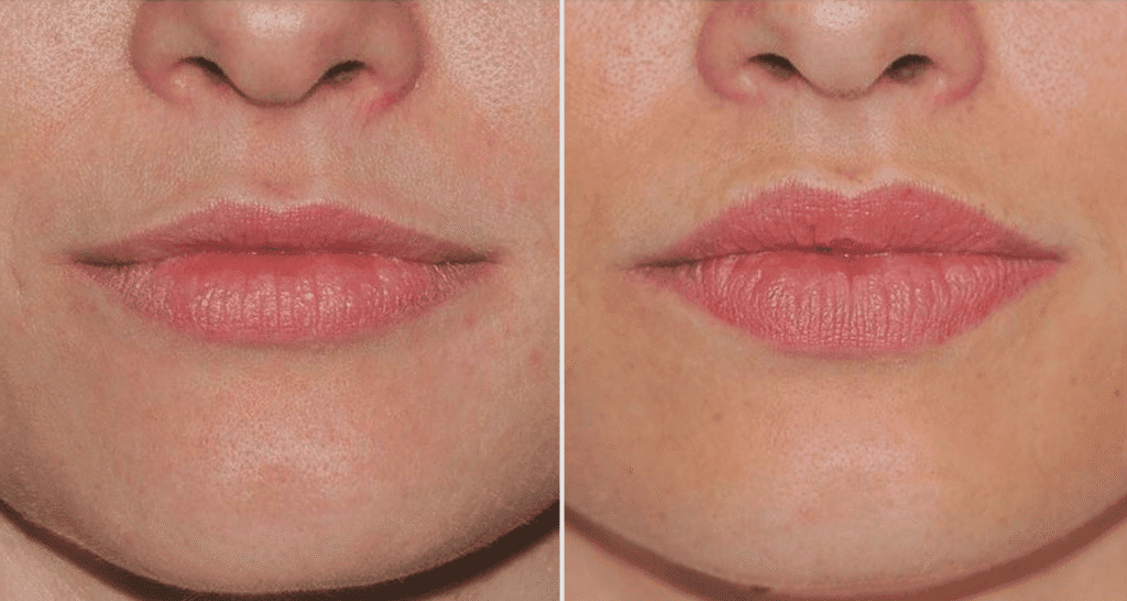 Vorher/Nachher Ergebnis: Eigenfett Lippen