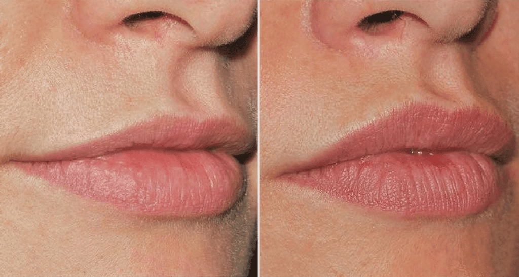 Vorher/Nachher Ergebnis: Eigenfett Lippen