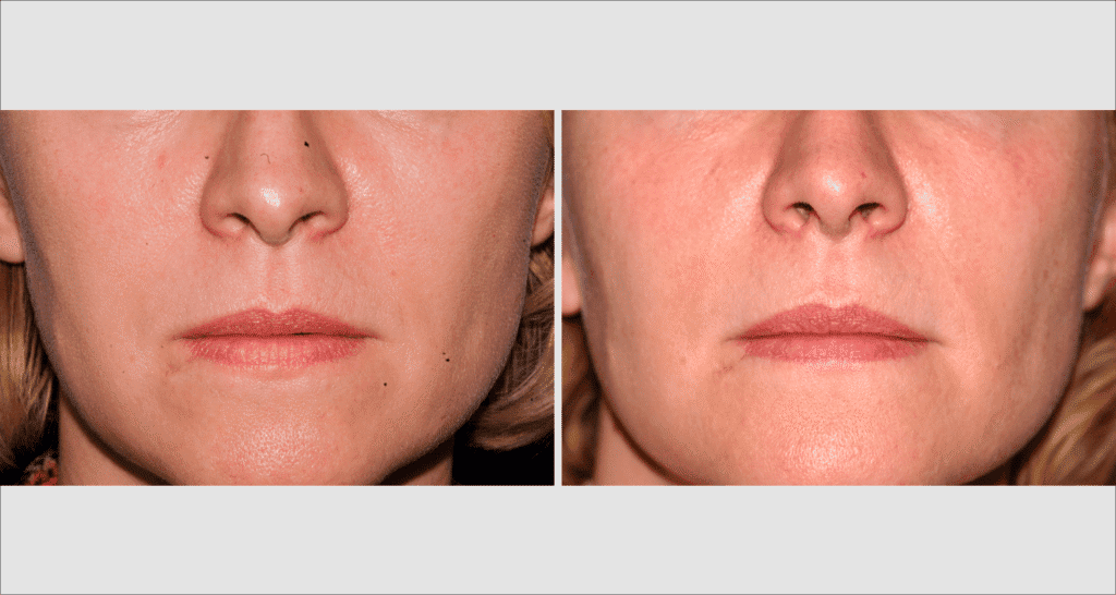 Vorher/Nachher Ergebnis: Eigenfett Nasolabialfalte