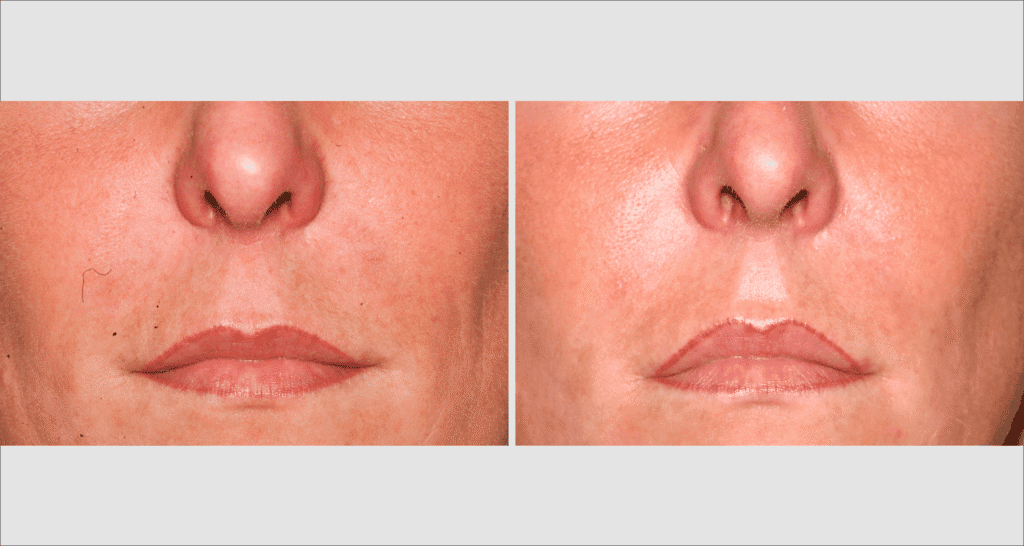 Vorher/Nachher Ergebnis: Eigenfett Nasolabialfalte