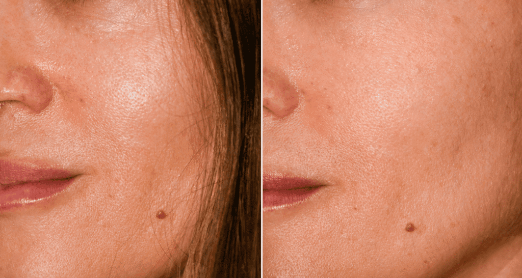 Vorher/Nachher Ergebnis: Eigenfett Nasolabialfalte