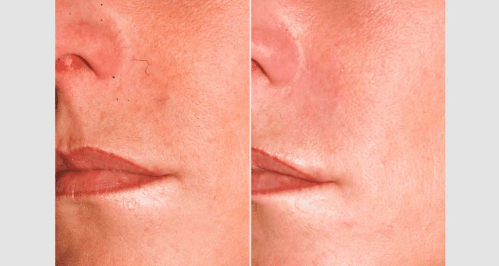 Vorher/Nachher Ergebnis: Eigenfett Nasolabialfalte