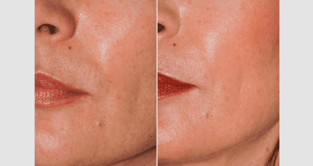 Vorher/Nachher Ergebnis: Eigenfett Nasolabialfalte