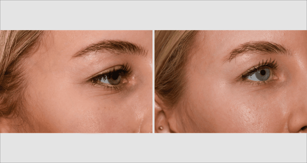 Vorher/Nachher Ergebnis: Eigenfett Schlaefen