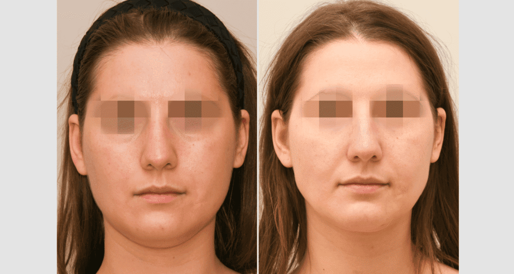 Vorher/Nachher Ergebnis: Eigenfett Schlaefen