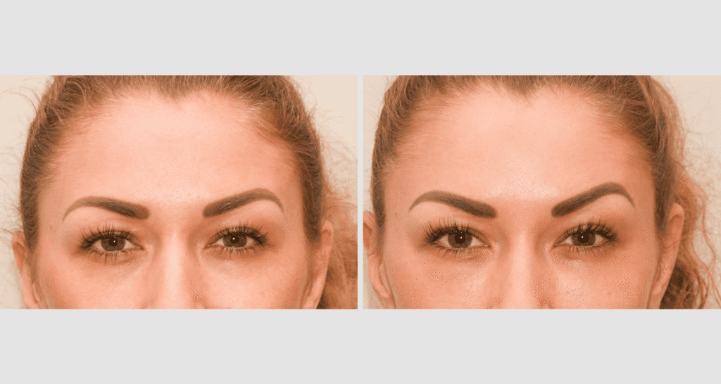 Vorher/Nachher Ergebnis: Eigenfett Schlaefen