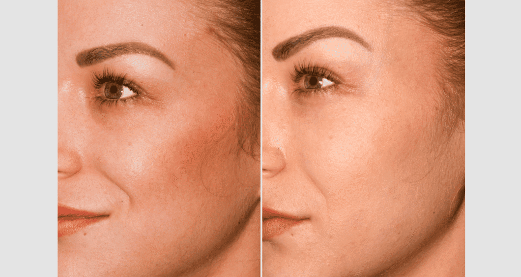 Vorher/Nachher Ergebnis: Eigenfett Schlaefen