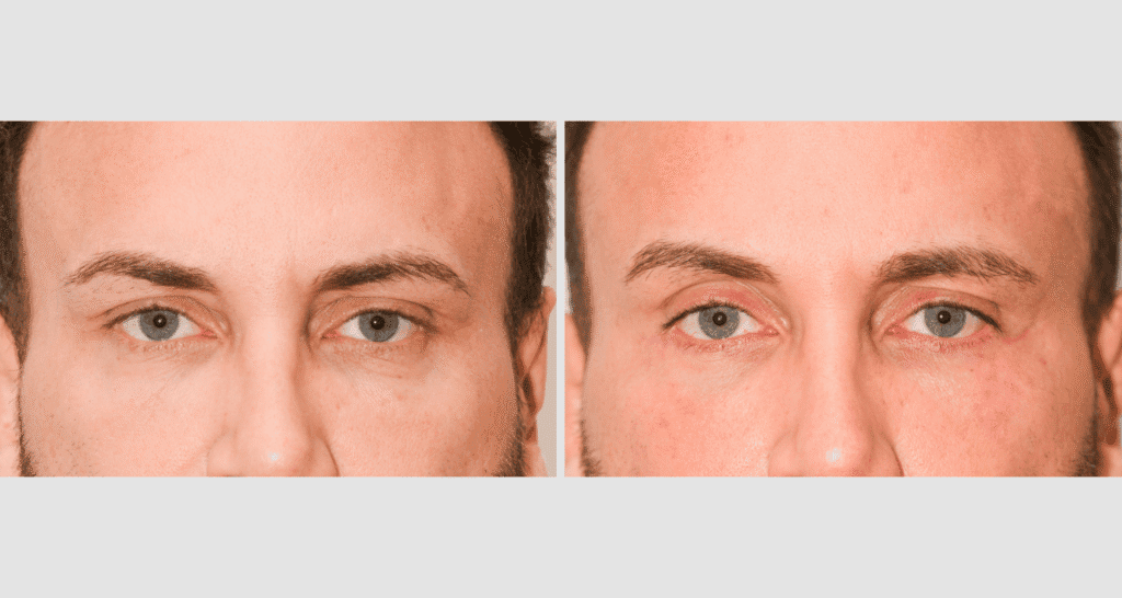 Vorher/Nachher Ergebnis: Eigenfett Schlaefen