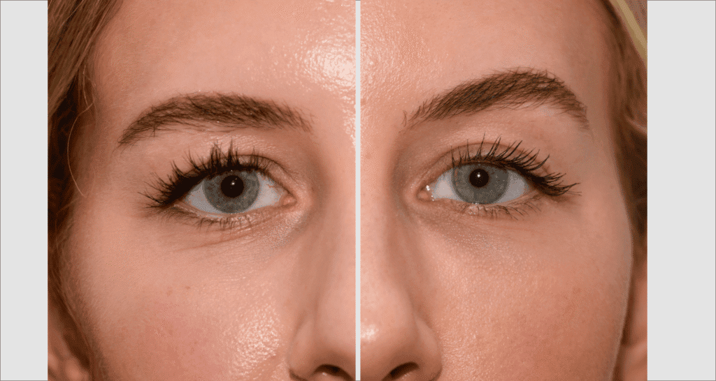 Vorher/Nachher Ergebnis: Eigenfett Schlaefen