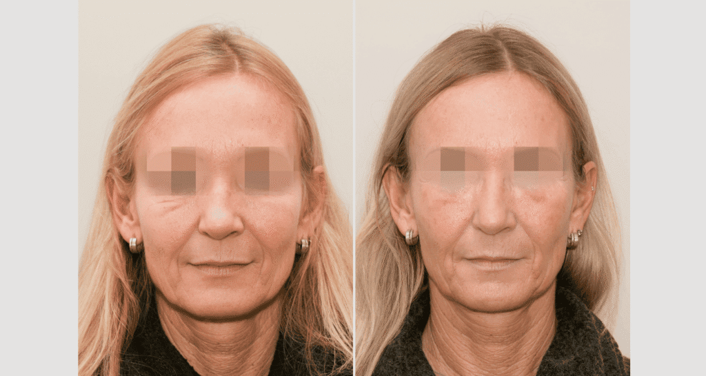 Vorher/Nachher Ergebnis: Eigenfett Schlaefen