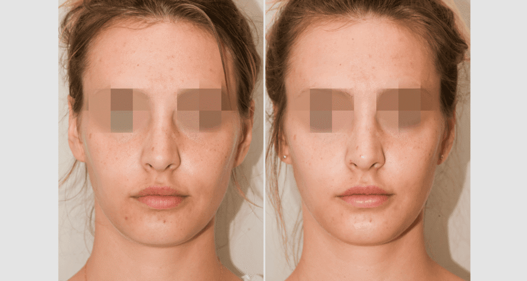 Vorher/Nachher Ergebnis: Eigenfett Schlaefen