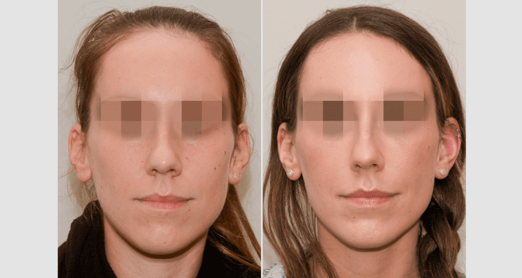 Vorher/Nachher Ergebnis: Eigenfett Schlaefen