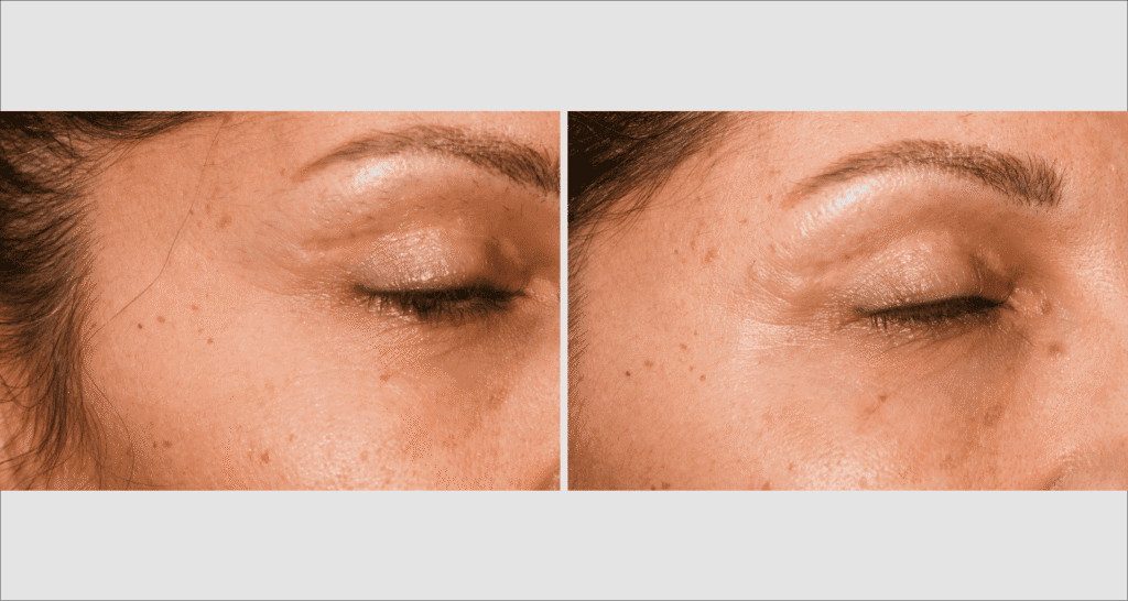 Vorher/Nachher Ergebnis: Eigenfett Schlaefen