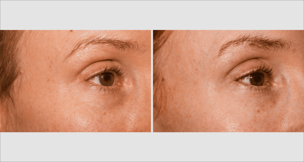 Vorher/Nachher Ergebnis: Eigenfett Schlaefen