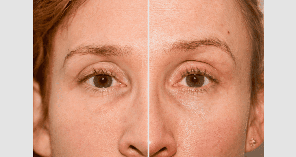 Vorher-Nachher Bild einer Eigenfetttransplantation bei Gesichtskorrektur.