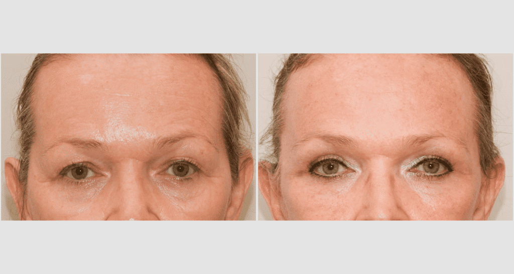 Vorher/Nachher Ergebnis: Eigenfett Schlaefen