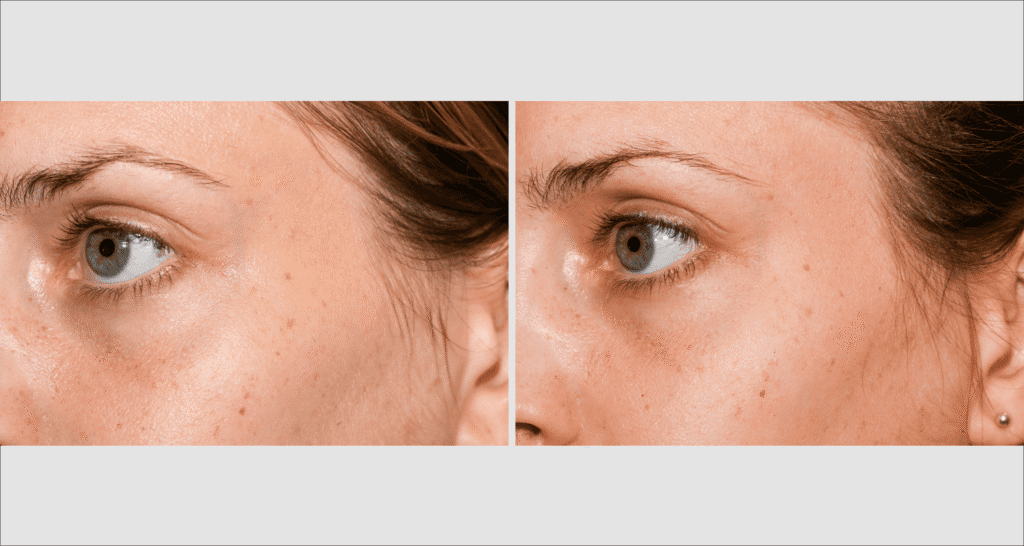 Vorher/Nachher Ergebnis: Eigenfett Schlaefen