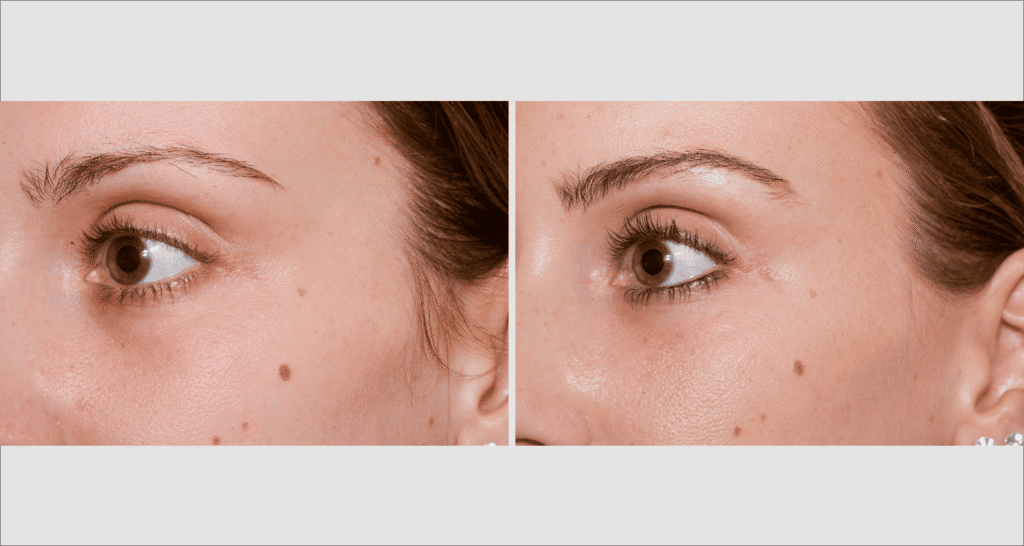 Vorher/Nachher Ergebnis: Eigenfett Schlaefen