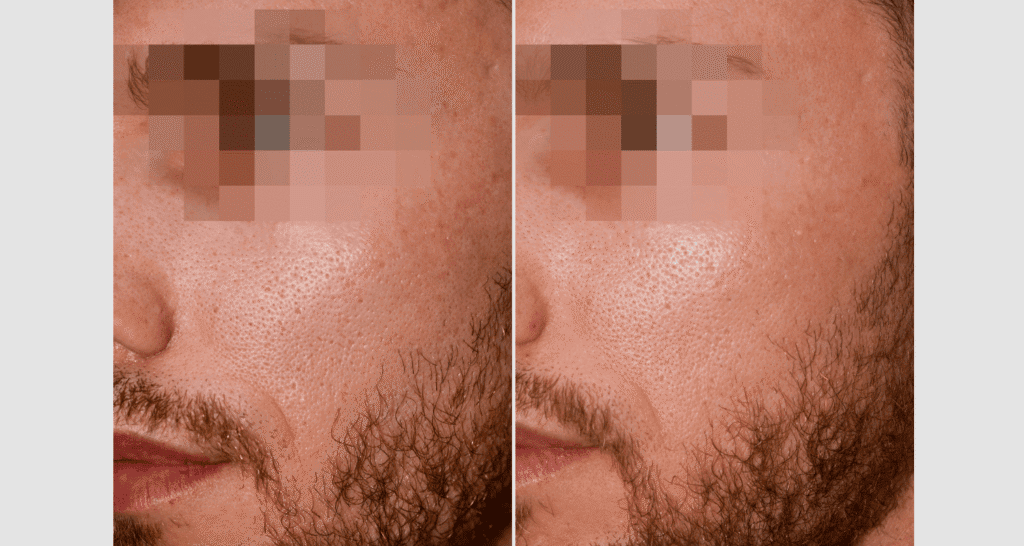 Vorher/Nachher Ergebnis: Eigenfett Wangen