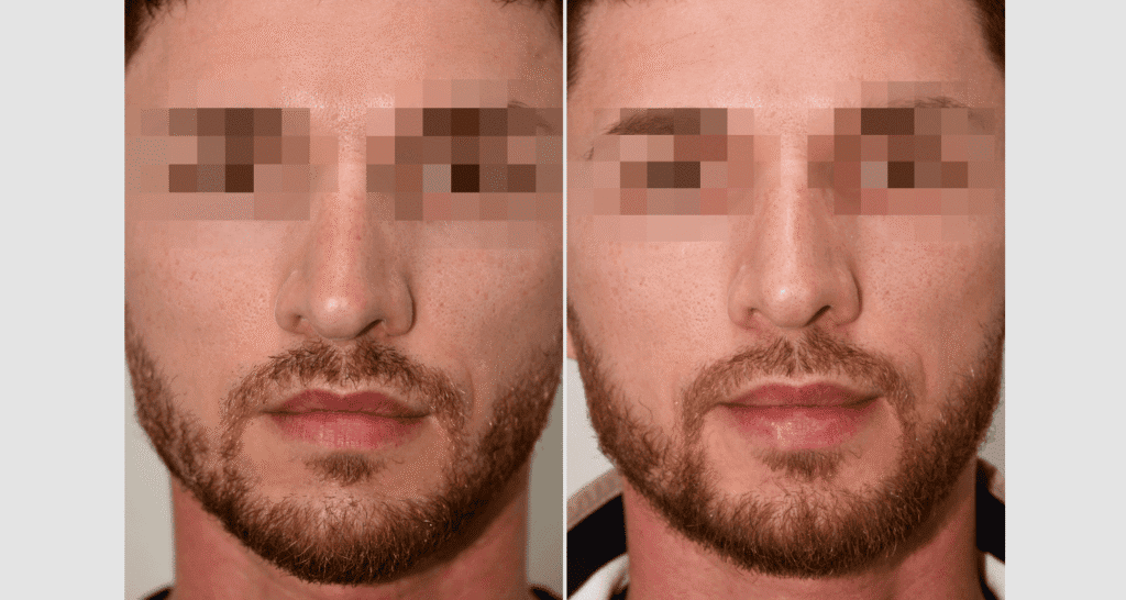 Vorher/Nachher Ergebnis: Eigenfett Wangen