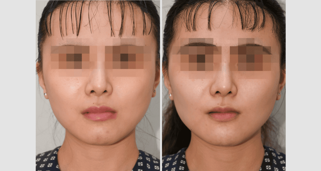 Vorher/Nachher Ergebnis: Eigenfett Wangen