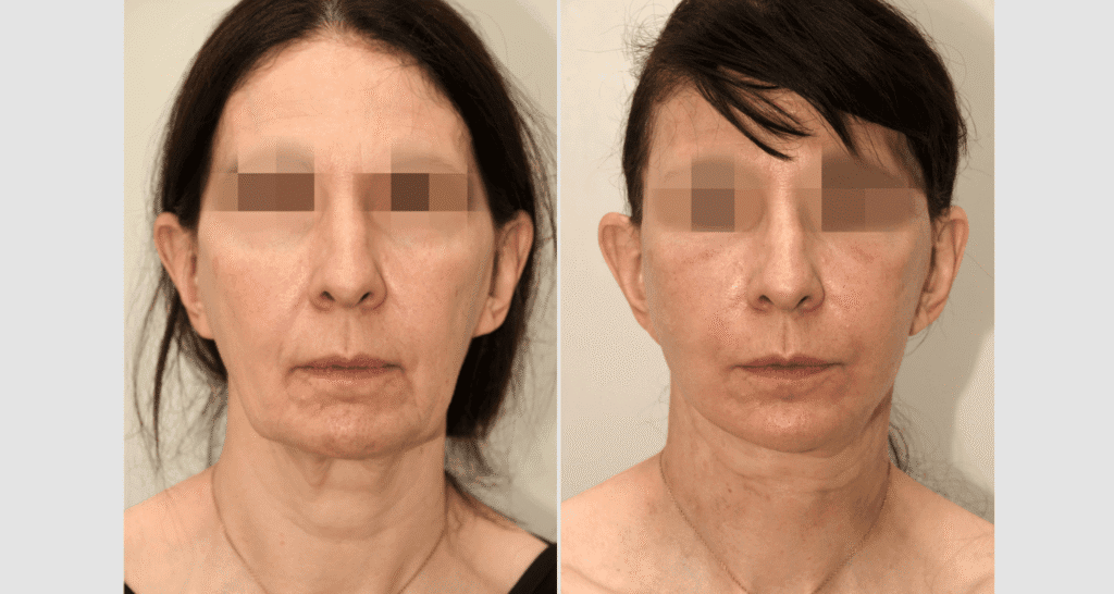Vorher/Nachher Ergebnis: Facelift