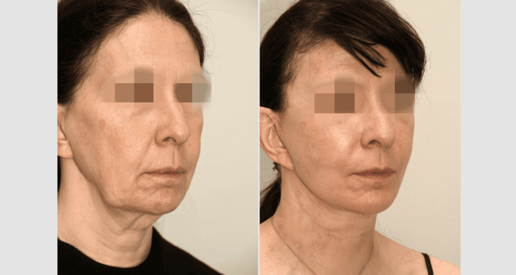Vorher/Nachher Ergebnis: Facelift