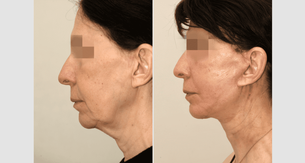 Vorher/Nachher Ergebnis: Facelift