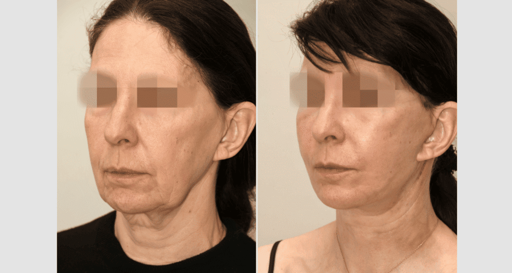Vorher/Nachher Ergebnis: Facelift