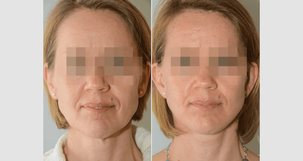 Vorher/Nachher Ergebnis: Facelift