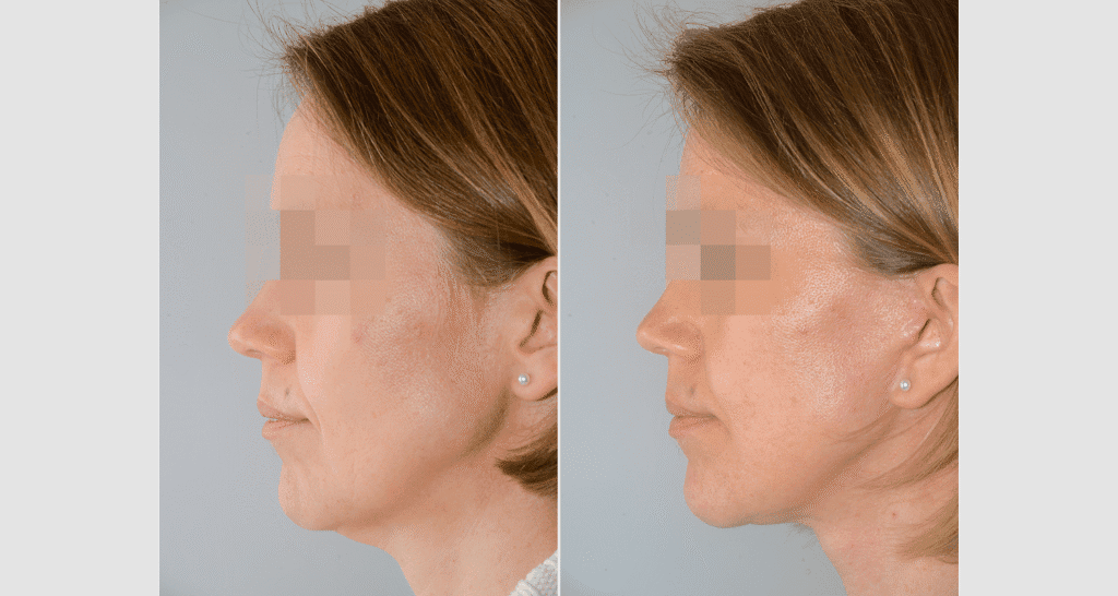 Vorher/Nachher Ergebnis: Facelift