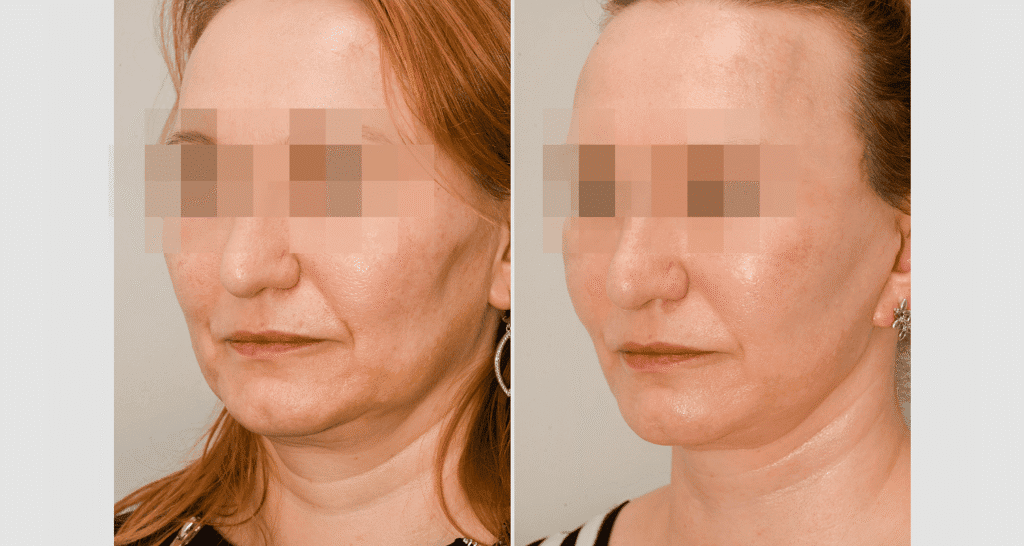 Vorher/Nachher Ergebnis: Facelift
