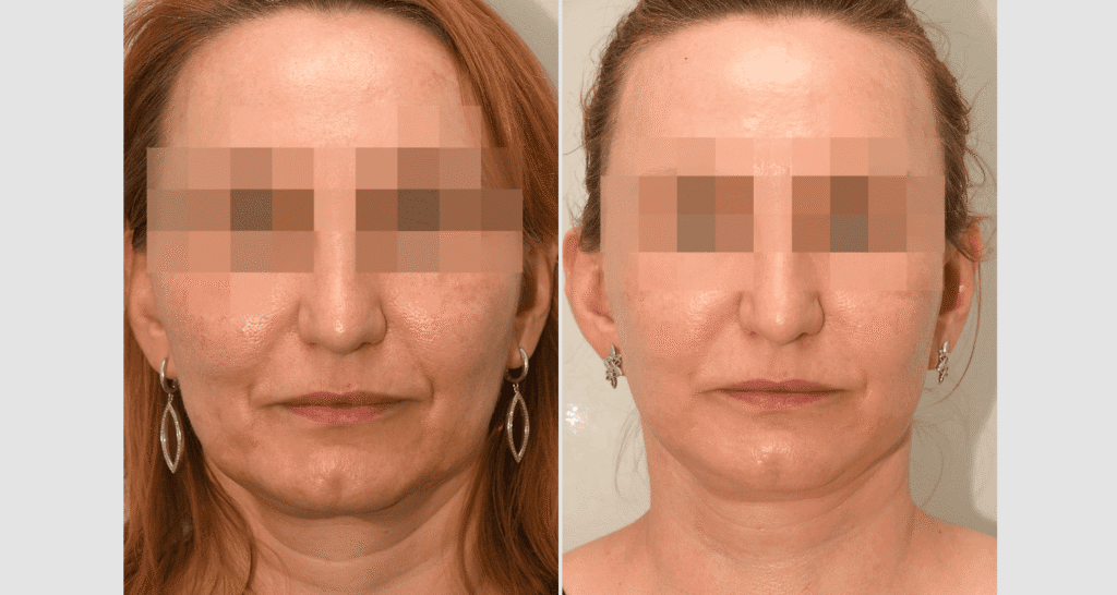 Vorher/Nachher Ergebnis: Facelift