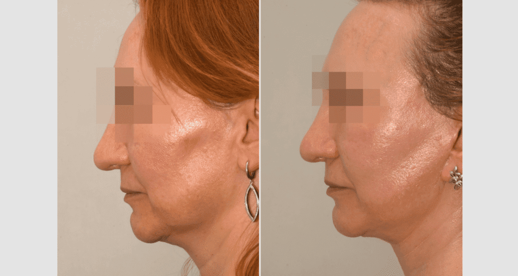 Vorher/Nachher Ergebnis: Facelift